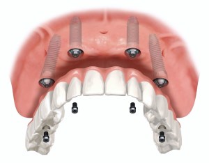 Illustration of an upper jaw with four dental implants supporting a full arch prosthesis.