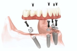 Illustration of a full arch dental implant restoration showing the placement of implants and prosthetic teeth.