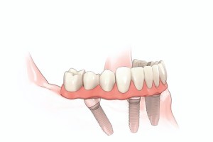 Image of dental implants